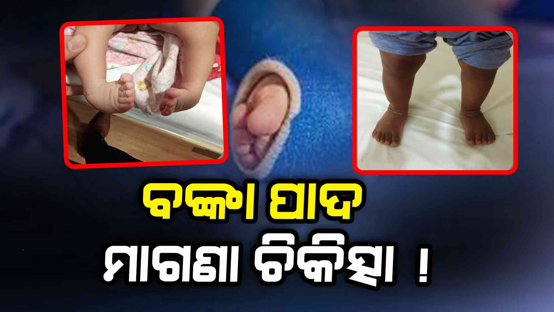 ସରକାର କରିଛନ୍ତି ଚୁକ୍ତି, ପିଲାଙ୍କ ବଙ୍କା ପାଦର ହେବ ମାଗଣା ଚିକିତ୍ସା !