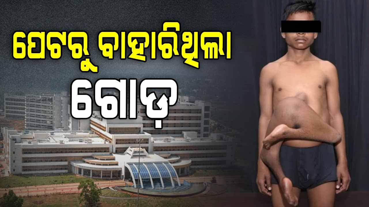 AIIMS ଲେଖିଲା ନୂଆ ଇତିିହାସ, ଅସ୍ତ୍ରୋପଚାର କରି ପେଟରୁ ଅଲଗା କଲା ଗୋଡ଼