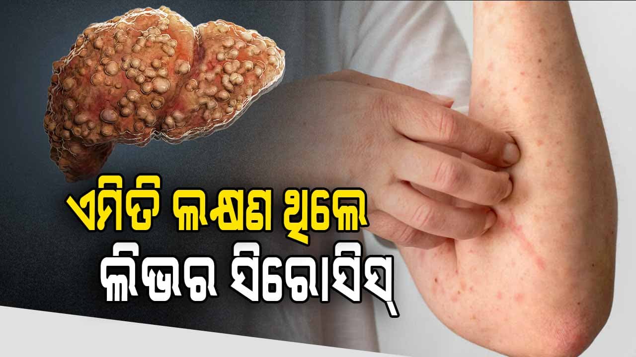 କାହିଁକି ହୁଏ ଲିଭର ସିରୋସିସ୍ ? ଜାଣନ୍ତୁ କାରଣ, ଲକ୍ଷଣ, ସମାଧାନ...