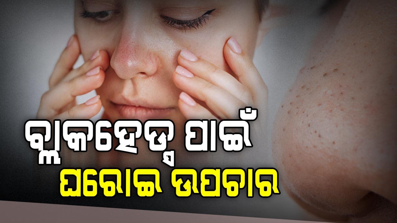 ଏହି ଘରୋଇ ଉପଚାର ଦ୍ୱାରା, ବ୍ଲାକହେଡ୍ସ ଏବଂ ବ୍ରଣ କିଛି ମିନିଟ୍ ମଧ୍ୟରେ ଦୂର ହୋଇଯିବ ଜାଣନ୍ତୁ... 