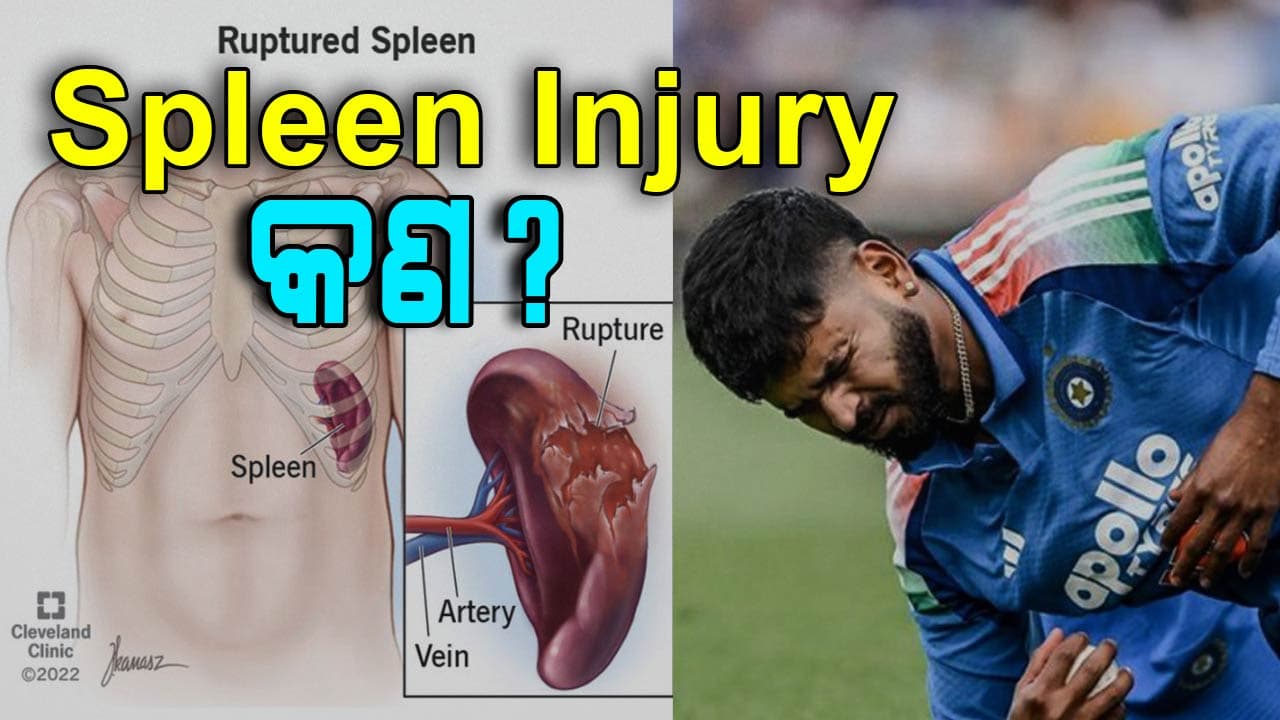 କ୍ୟାଚ୍ ପଡ଼ିଲା ଭାରି: ଶ୍ରେୟସ ଆୟରଙ୍କୁ Spleen Laceration....ଚାଲନ୍ତୁ ଜାଣିବା ଏହି ରୋଗ ବିଷୟରେ...
