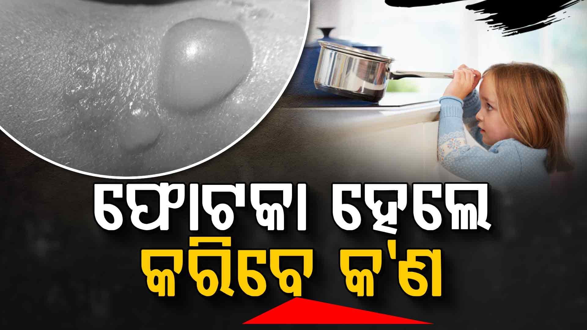 ଯଦି ଆପଣଙ୍କ ପିଲା ଉପରେ ଗରମ ପାଣି ଢାଳିଯାଏ ତେବେ କଣ କରିବେ ? 