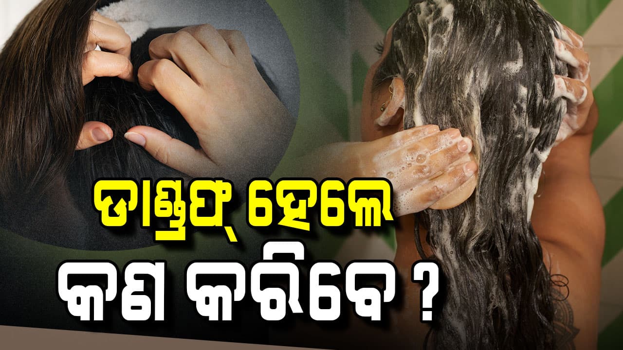 ଡାଣ୍ଡ୍ରଫ୍ କେତେ ପ୍ରକାରର? ଏହି ଘରୋଇ ଉପଚାର ସାହାଯ୍ୟରେ ପାଆନ୍ତୁ ମୁକ୍ତି 