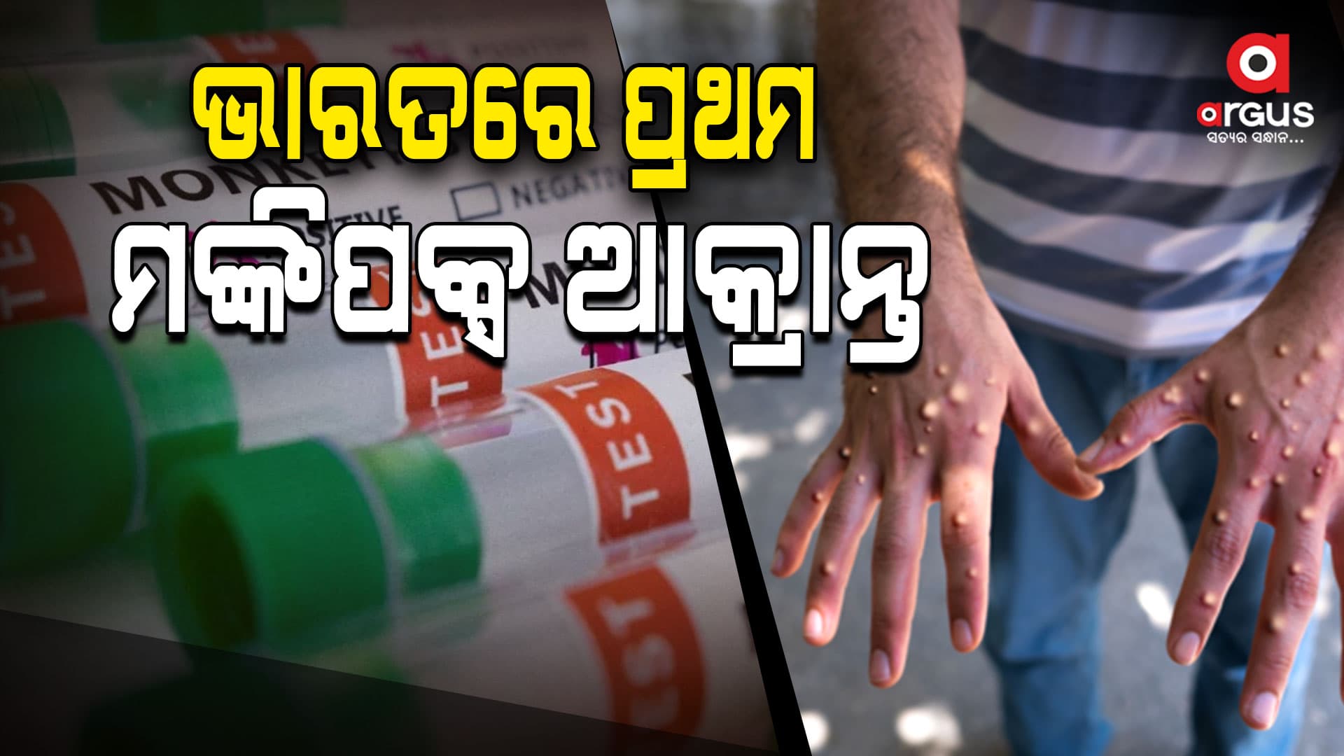 ଭାରତରେ ପ୍ରଥମ ମଙ୍କିପକ୍ସ ଆକ୍ରାନ୍ତ ଚିହ୍ନଟ