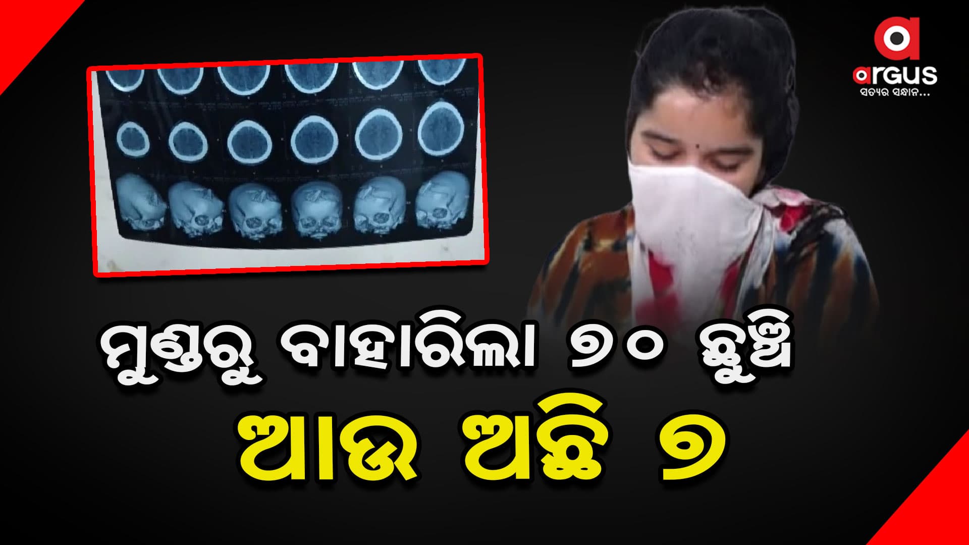 ଯୁବତୀଙ୍କ ମୁଣ୍ଡରୁ ବାହାରିଲା ୭୦ ଛୁଞ୍ଚି,  ଆଜି ବାହାରିବ ଆଉ  ୭ 