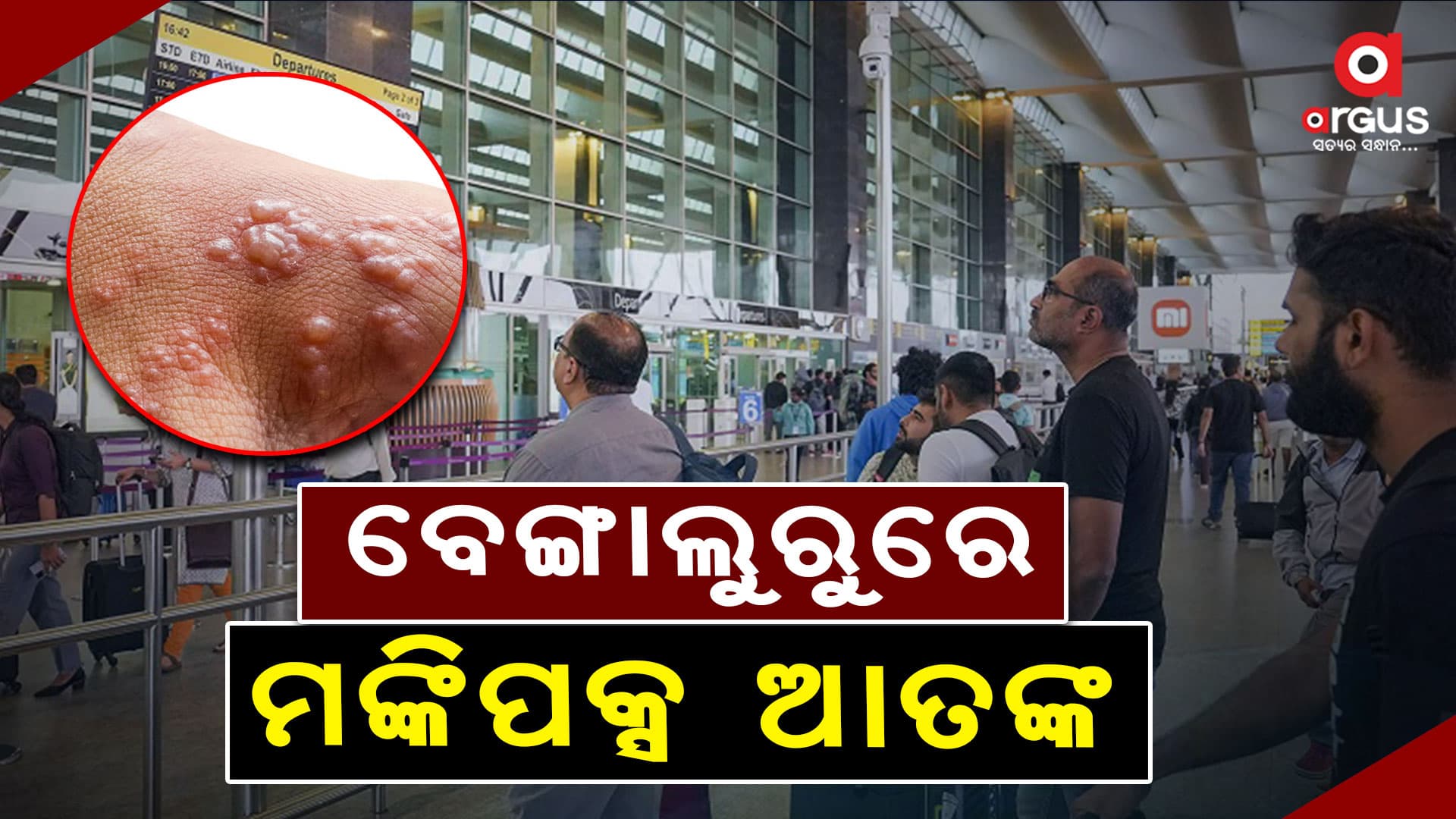 ଡରାଇଲାଣି ମଙ୍କିପକ୍ସ: ଆଲର୍ଟରେ ବେଙ୍ଗାଲୁରୁ ବିମାନବନ୍ଦର