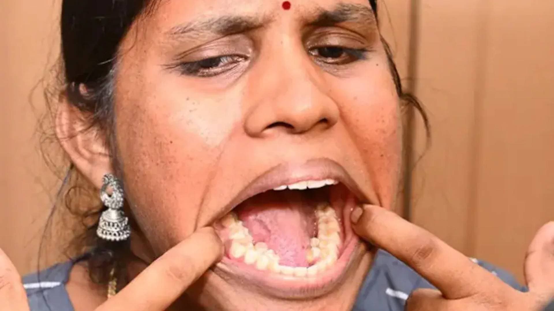 Indian Woman Sets Guinness World Record For Having 38 Teeth