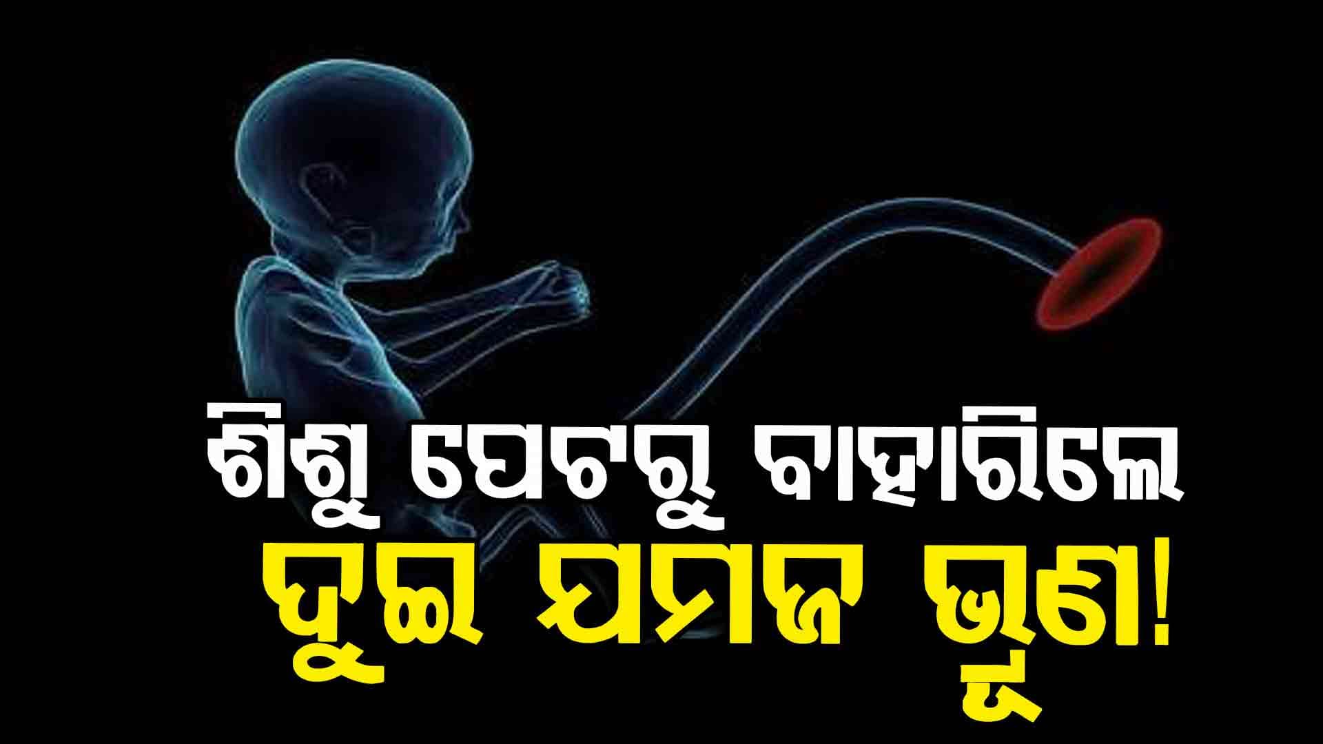 ଗୁରୁଗ୍ରାମର ଡାକ୍ତରମାନେ ବିରଳ ଅସ୍ତ୍ରୋପଚାର କରି ଶିଶୁର ପେଟରୁ ଦୁଇଟି ଯମଜ ଶିଶୁଙ୍କୁ ବାହାର କରିଛନ୍ତି