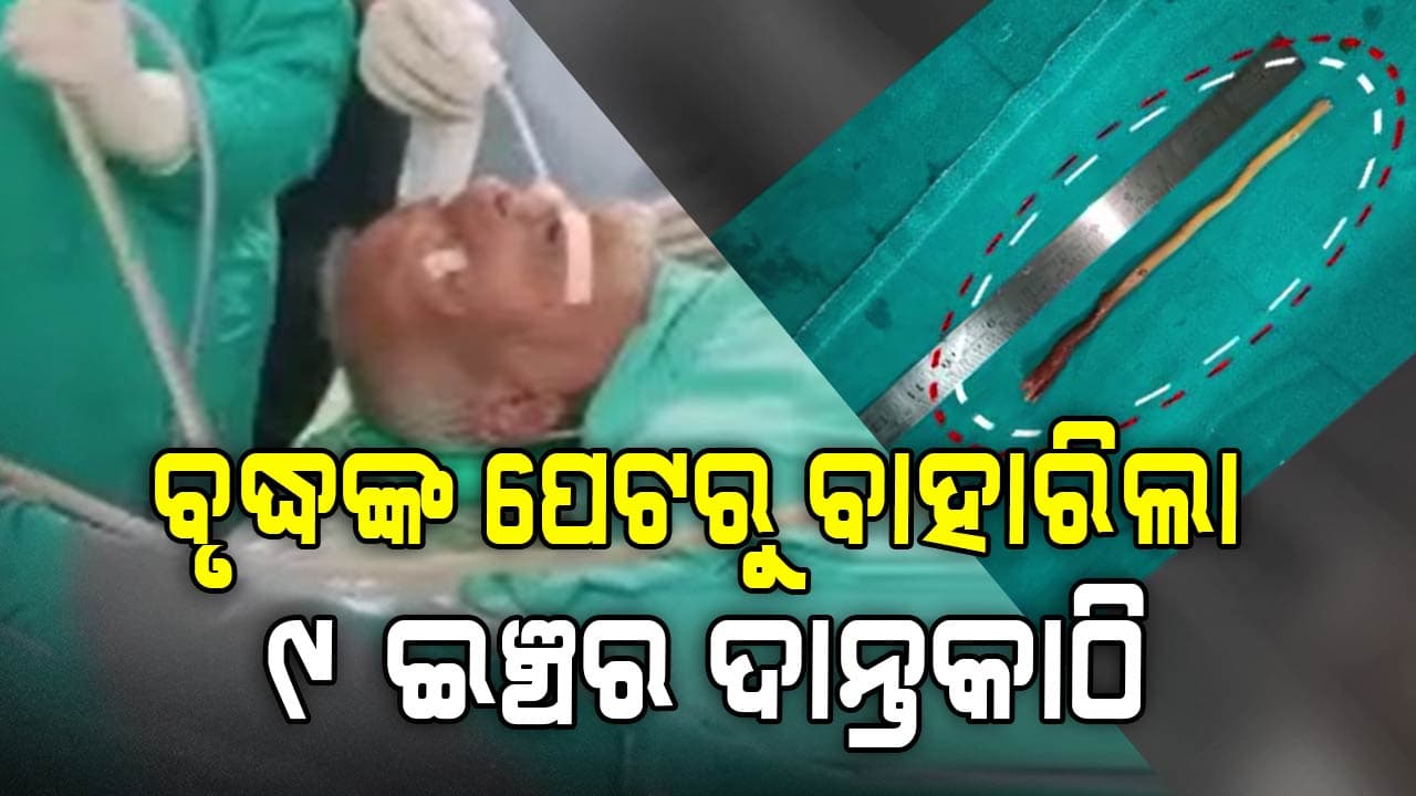ବୃଦ୍ଧଙ୍କ ଖାଦ୍ୟନଳୀରୁ ବାହାରିଲା ୯ ଇଞ୍ଚର ଦାନ୍ତକାଠି