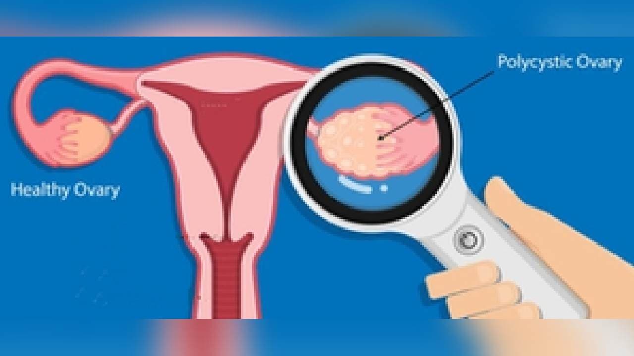 Routine screening key for early detection of ovarian cancer: Experts