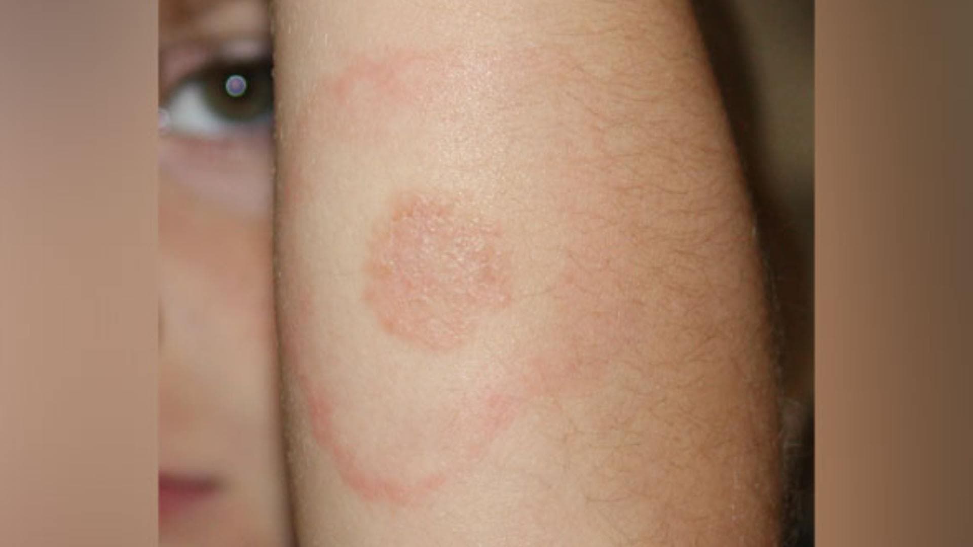 Lyme Disease Reported In Kerala's Ernakulam