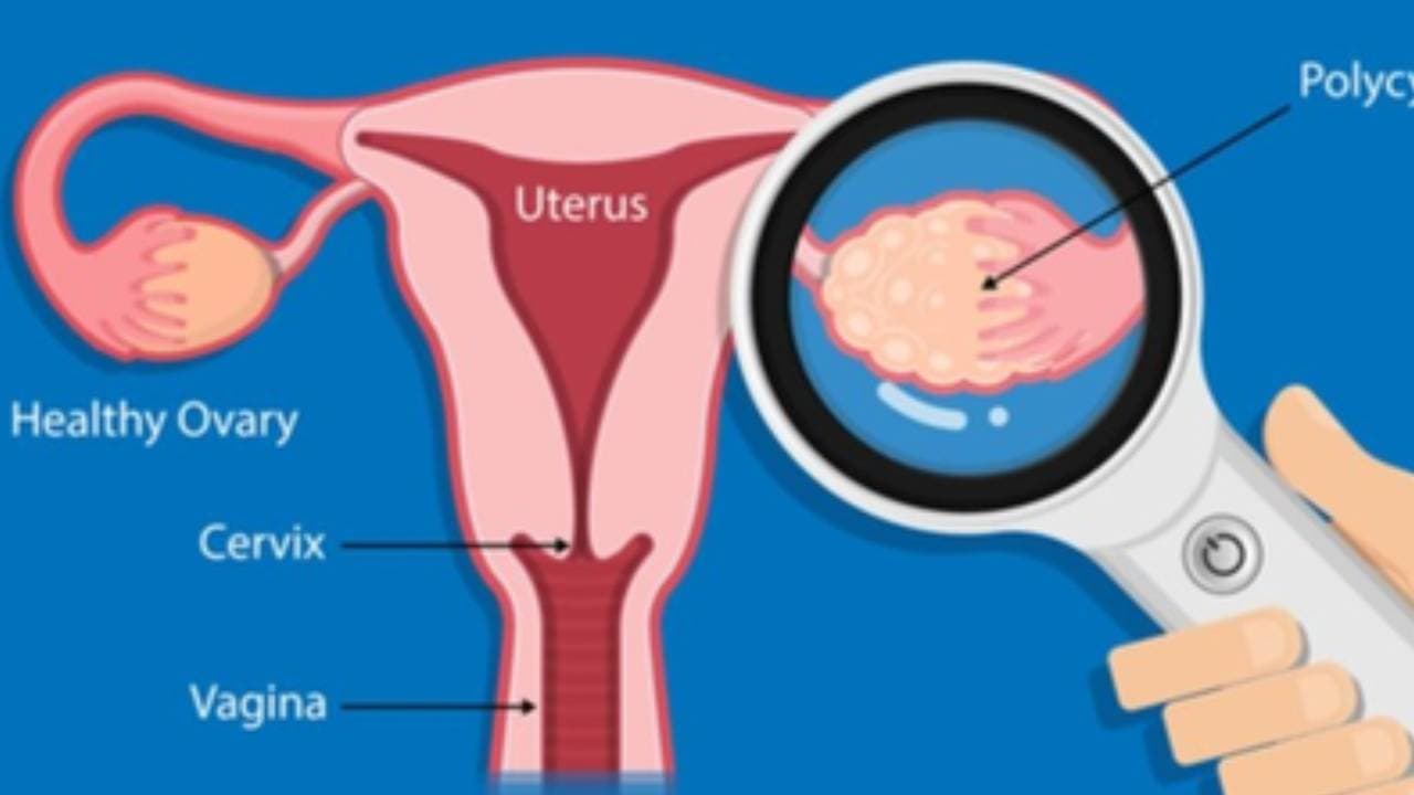 Women With PCOS More Likely To Have Memory, Thinking Issues In Middle Age: Study