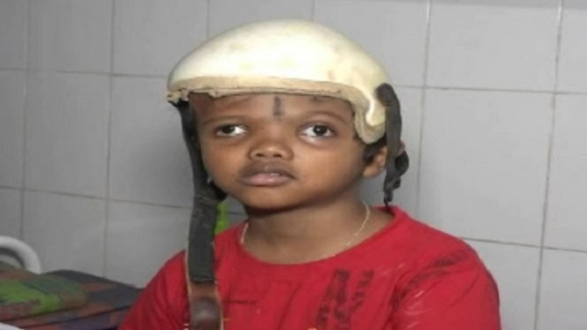Conjoined Twins Survivor Jaga Injured In Attack On Phulbani Hospital Premises